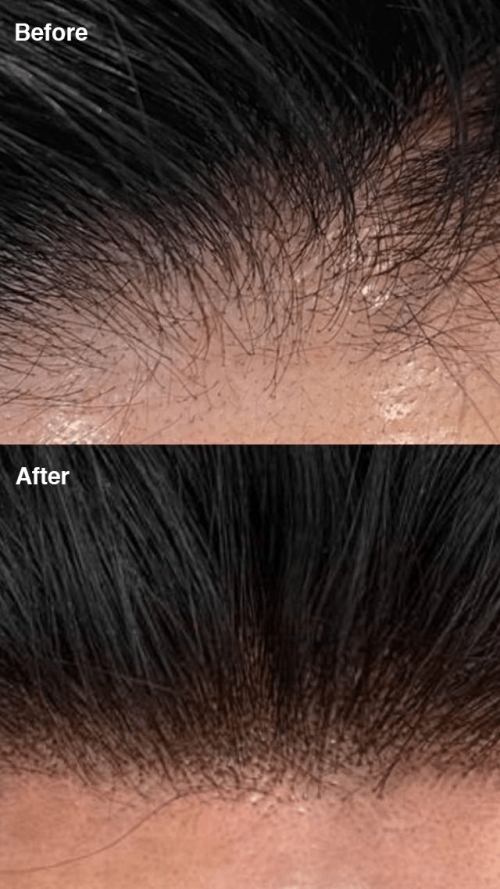 Before and After Scalp Micropigmentation